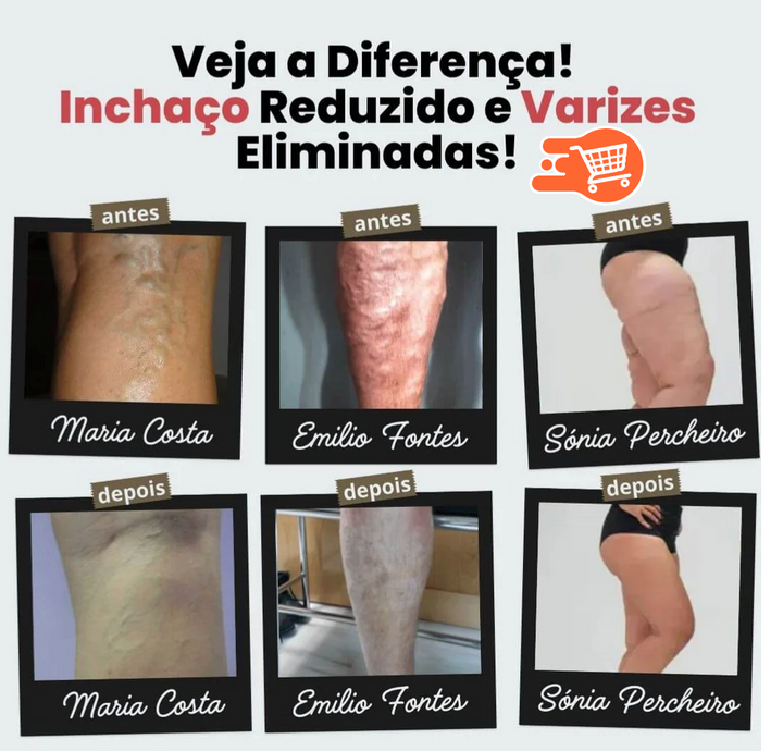 Calcetines de acupresión antivarices