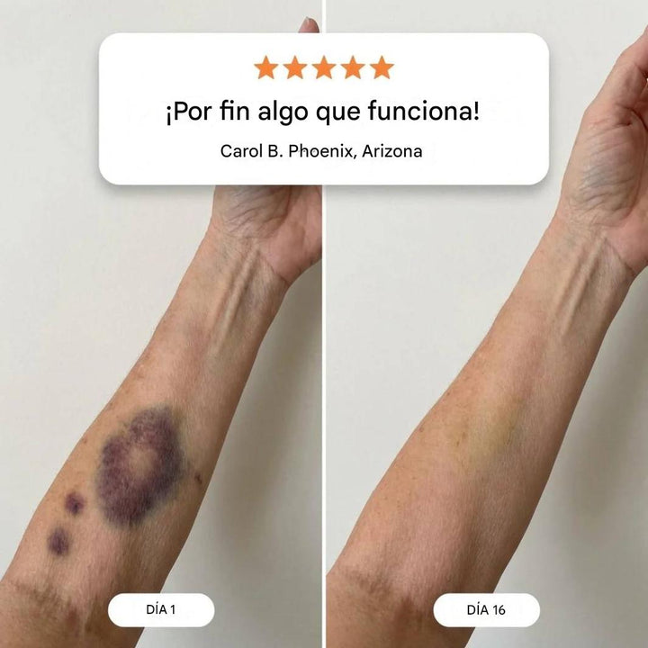 DermaRepair | Cuidado de Moretones